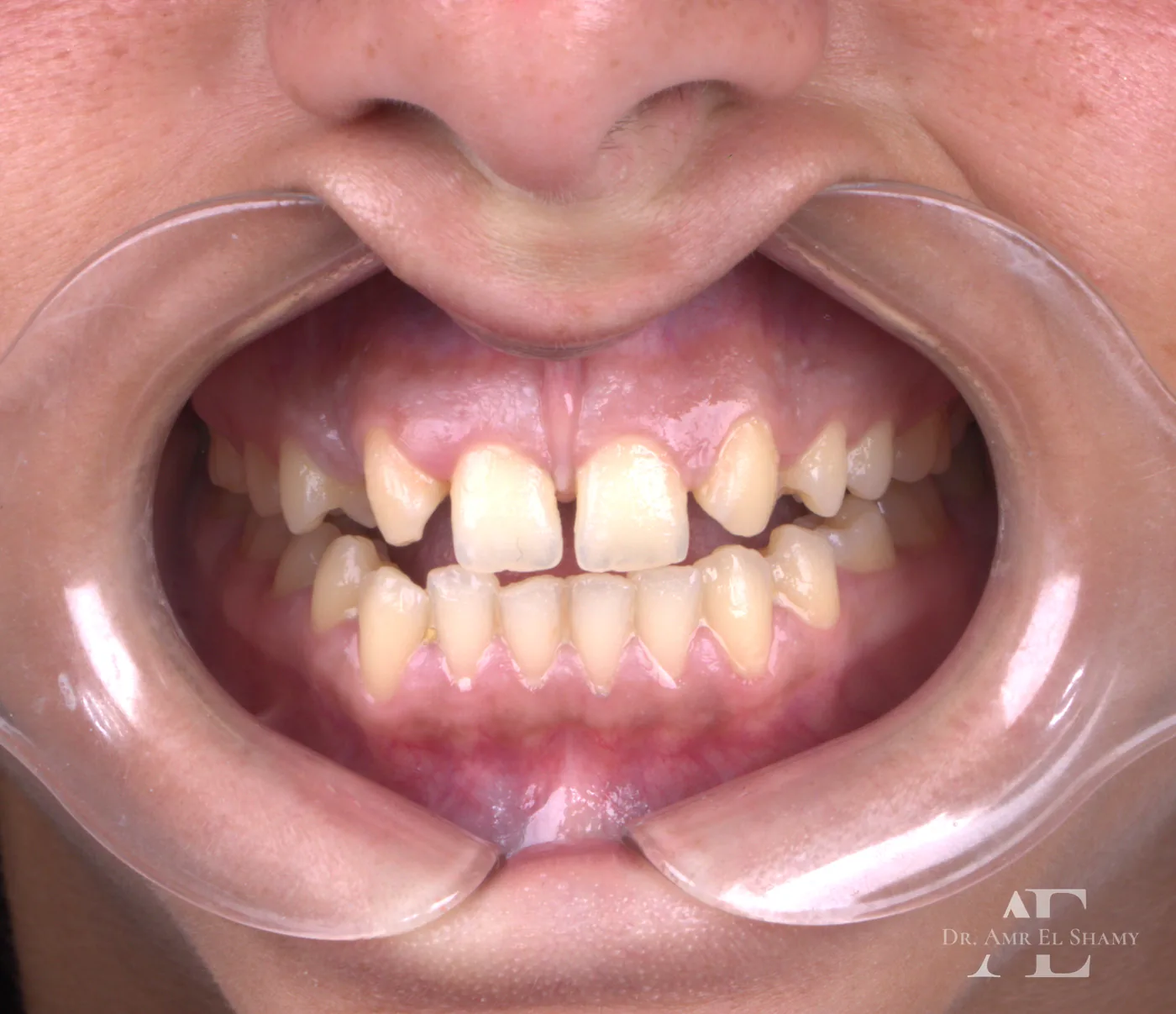 Case 4 before